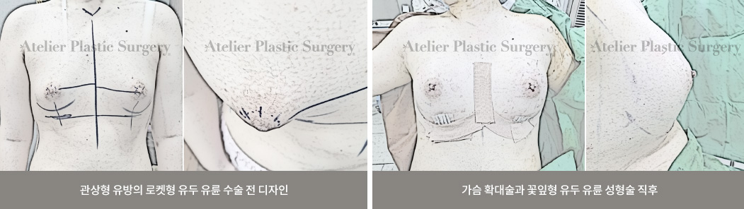 管状乳房的火箭形乳头乳晕手术前设计 / 隆胸术和花瓣形乳头乳晕整形术后即刻