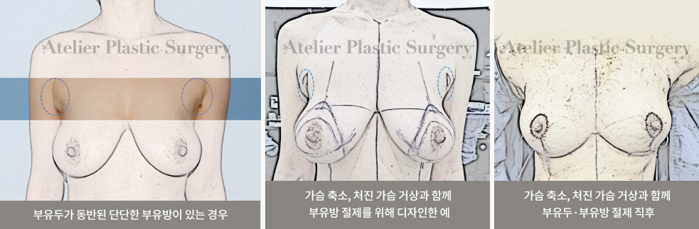 伴有副乳头的坚硬副乳情况 / 为胸部缩小、下垂胸部提升和副乳切除设计的示例 / 胸部缩小、下垂胸部提升和副乳头・副乳切除术后即刻