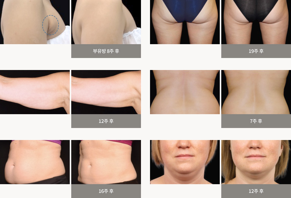 副乳8周后 / 19周后 / 12周后 / 7周后 / 16周后 / 12周后