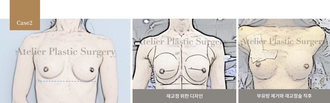 재교정 위한 디자인 / 부유방 제거와 재교정술 직후