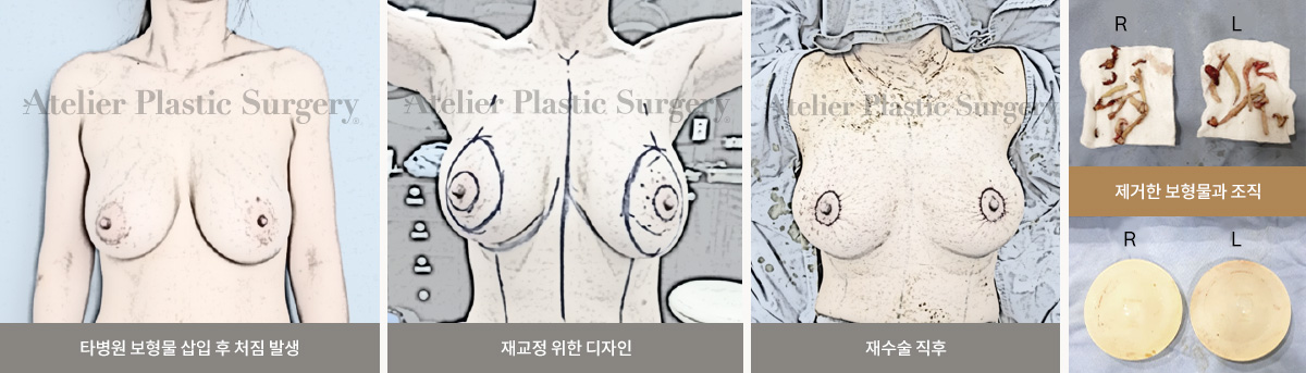 타병원 보형물 삽입 후 처짐 발생 / 재교정 위한 디자인 / 재수술 직후 / 제거한 보형물과 조직