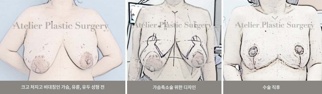 크고 처지고 비대칭인 가슴, 유륜, 유두 성형 전 / 가슴축소술 위한 디자인 / 수술 직후