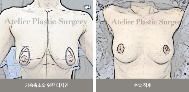 가슴축소술 위한 디자인 / 수술 직후