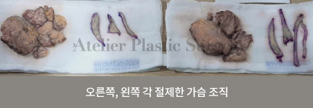 오른쪽, 왼쪽 각 절제한 가슴조직