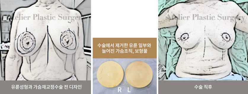 유륜성형과 가슴재교정수술 전 디자인 / 수술에서 제거한 유륜 일부와 늘어진 가슴조직, 보형물 / 수술 직후