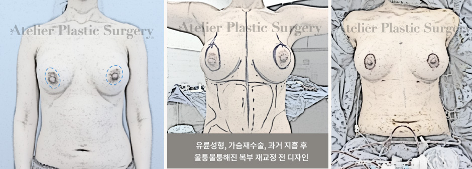 유륜성형, 가슴재수술, 과거 지흡 후 울퉁불퉁해진 복부 재교정 전 디자인