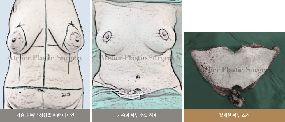 가슴과 복부 성형을 위한 디자인 / 가슴과 복부 수술 직후 / 절개한 복부 조직