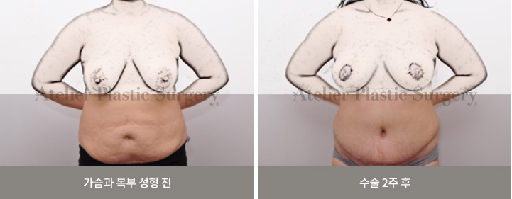 가슴과 복부 성형 전 / 수술 2주 후