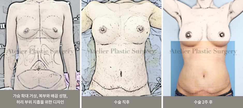 가슴 확대 거상, 복부와 배꼽 성형, 허리 부위 지흡을 위한 디자인 / 수술 직후 / 수술 2주 후