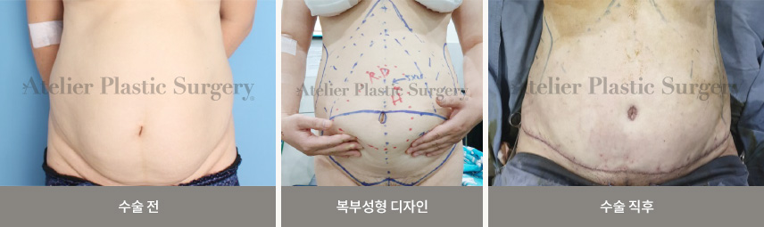 수술 전 / 복부성형 디자인 / 수술 직후