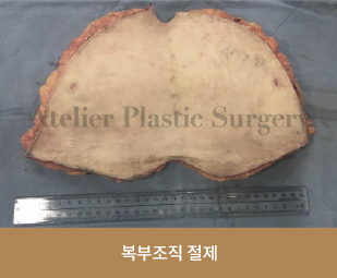 복부조직 절제
