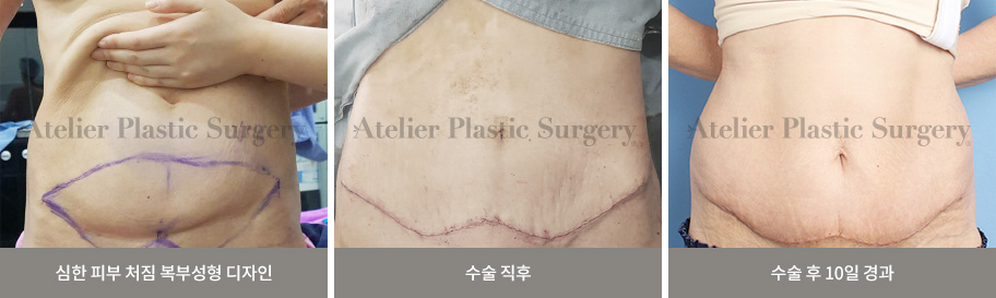 심한 피부 처짐 복부성형 디자인 / 수술 직후 / 수술 후 10일 경과