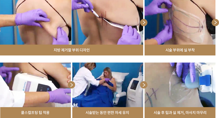지방 제거할 부위 디자인 > 시술 부위에 실 부착 > 쿨스컬프팅 팁 적용 > 시술받는 동안 편한 자세 유지 > 시술 후 팁과 실 제거, 마사지 마무리