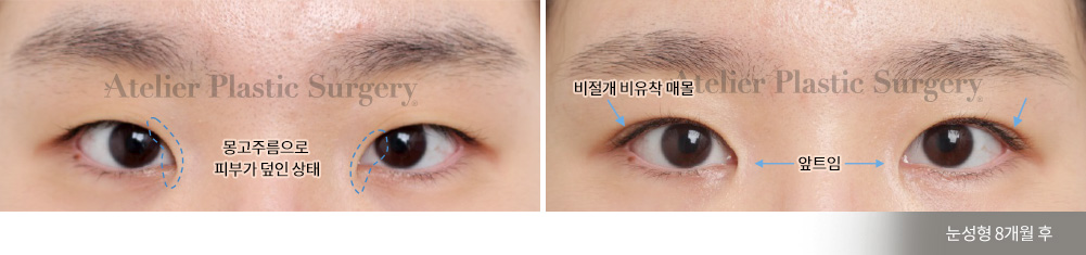 몽고주름으로 피부가 덮인 상태 > 비절개 비유착 매몰, 앞트임(눈성형 8개월 후)