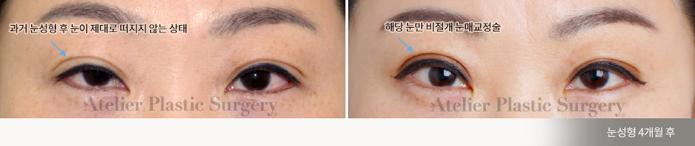 과거 눈성형 후 눈이 제대로 떠지지 않는 상태 > 해당 눈만 비절개 눈매교정술(눈성형 4개월 후)