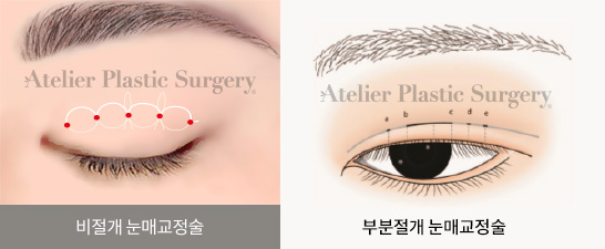 비절개 눈매교정술 / 부분절개 눈매교정술