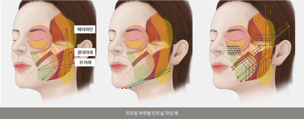리프팅 부위별 민트실 자입 예