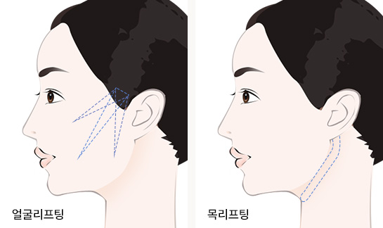좌측 이미지 : 얼굴리프팅 / 우측 이미지 : 목리프팅