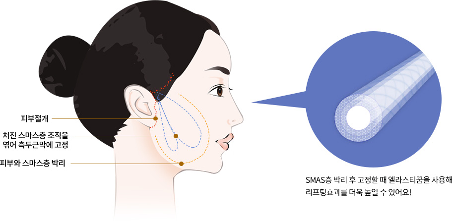 SMAS층 박리 후 고정할 때 엘라스티꿈을 사용해 리프팅효과를 더욱 높일 수 있어요!