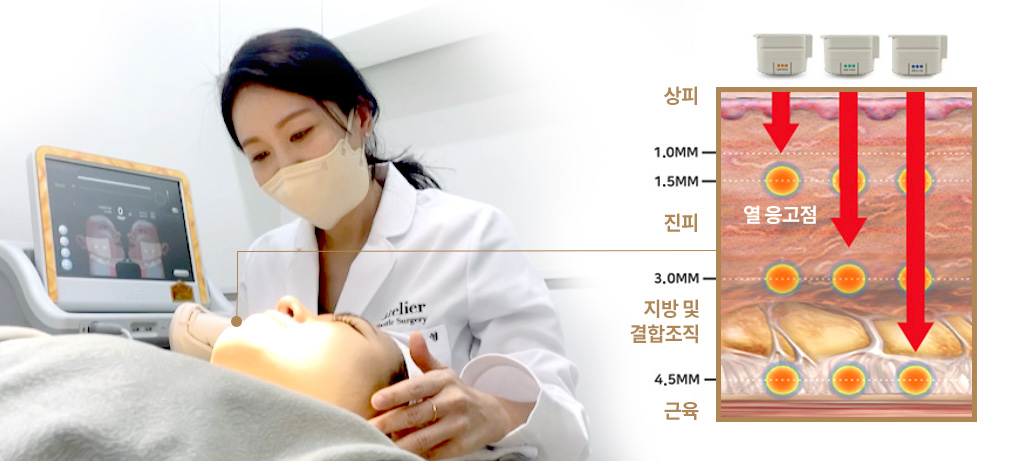 울쎄라 시술 사진