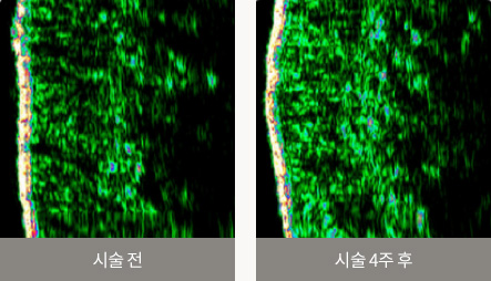 시술 전 / 시술 4주 후