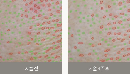 시술 전 / 시술 4주 후