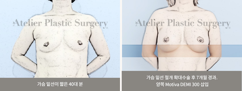 가슴 밑선이 짧은 40대 분 / 가슴 밑선 절개 확대수술 후 7개월 경과. 양쪽 Motiva DEMI 300 삽입