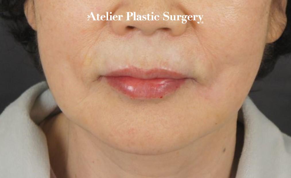 70대 안면거상 (face lifting) + 입술 필러, 무너진 턱 라인과 목주름 해결 더 건강한 입술 치료 후