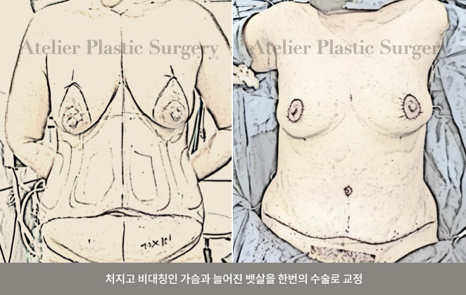たるんで非対称な胸と伸びたお腹を一度の手術で矯正