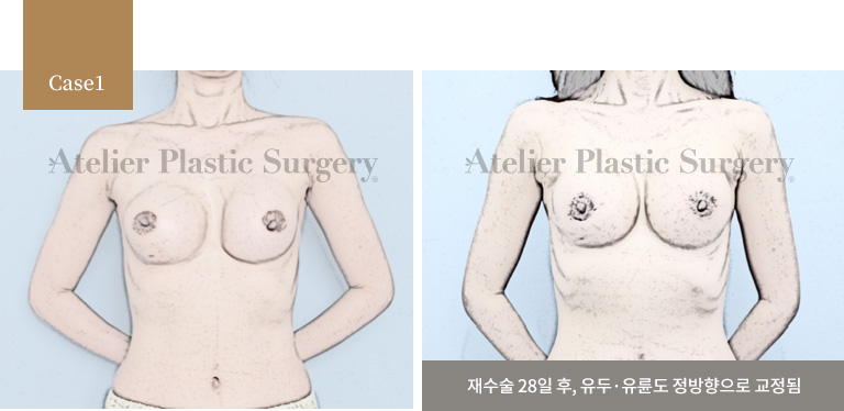 재수술 28일 후, 유두·유륜도 정방향으로 교정됨