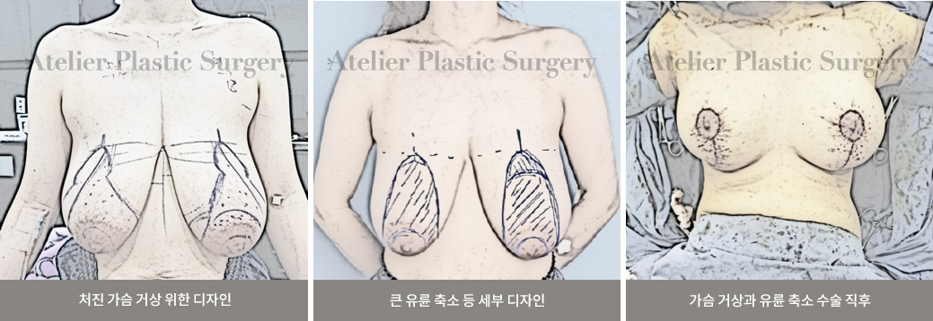 처진 가슴 거상 위한 디자인 / 큰 유륜 축소 등 세부 디자인 / 가슴 거상과 유륜 축소 수술 직후