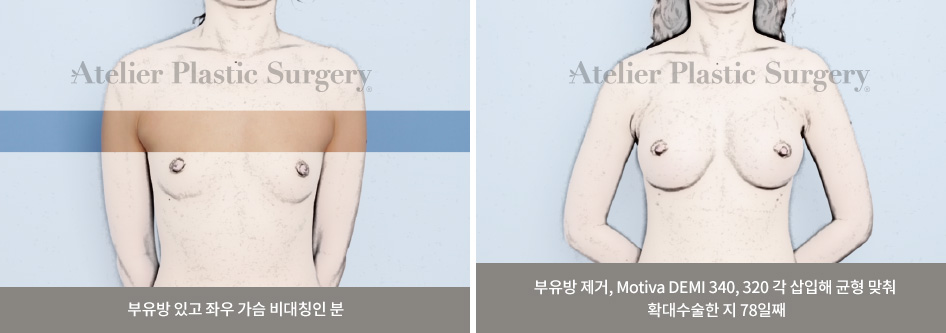 부유방 있고 좌우 가슴 비대칭인 분 / 부유방 제거, Motiva DEMI 340, 320 각 삽입해 균형 맞춰 확대수술한 지 78일째