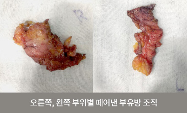 오른쪽, 왼쪽 부위별 떼어낸 부유방 조직
