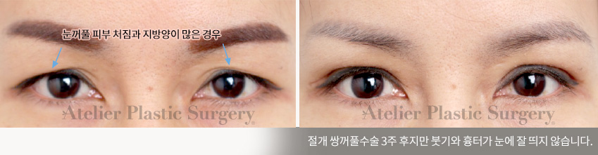 눈꺼풀 피부 처짐과 지방양이 많은 경우  > 절개 쌍꺼풀수술 3주 후지만 붓기와 흉터가 눈에 잘 띄지 않습니다.
