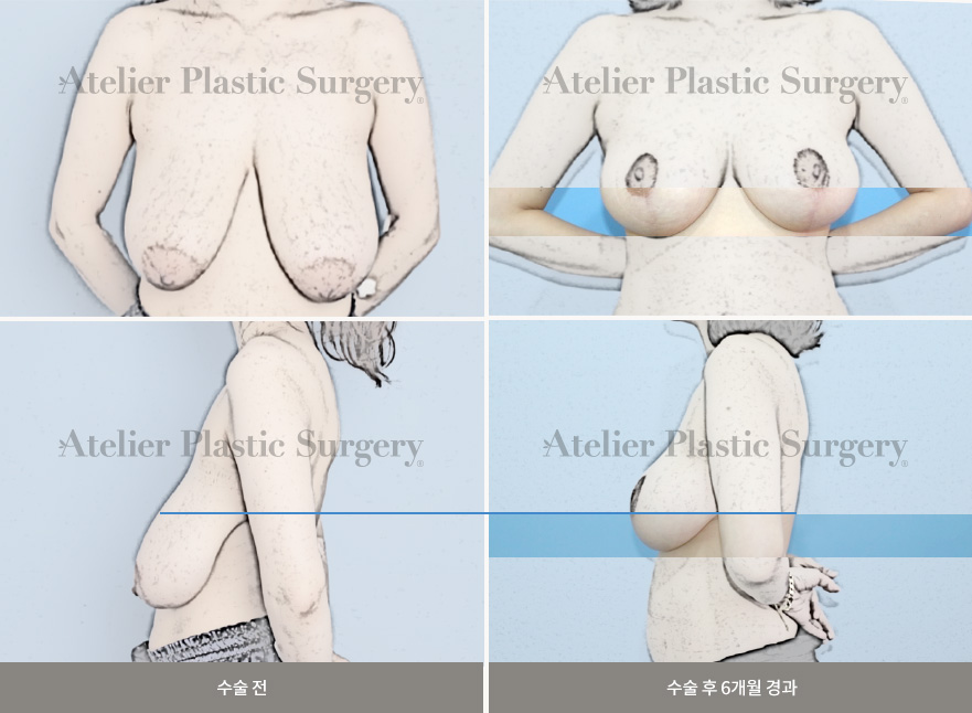수술 전 / 수술 후 6개월 경과