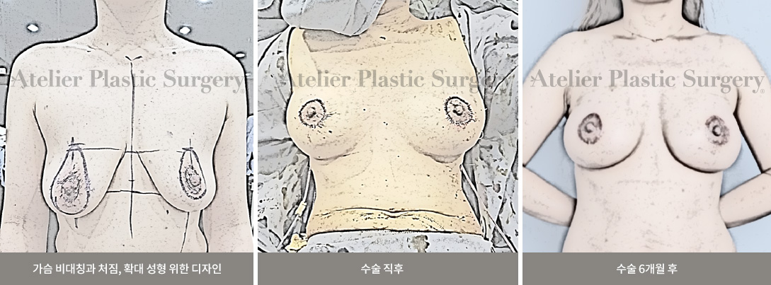 가슴 비대칭과 처짐, 확대 성형 위한 디자인 / 수술 직후 / 수술 6개월 후