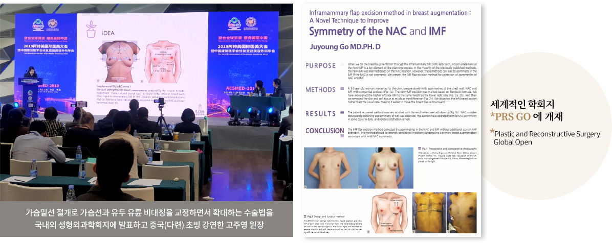 가슴밑선 절개로 가슴선과 유두 유륜 비대칭을 교정하면서 확대하는 수술법을 국내외 성형외과학회지에 발표하고 중국(다련) 초빙 강연한 고주영 원장 / 세계적인 학회지 PRS GO(Plastic and Reconstructive Surgery Global Open)에 개재