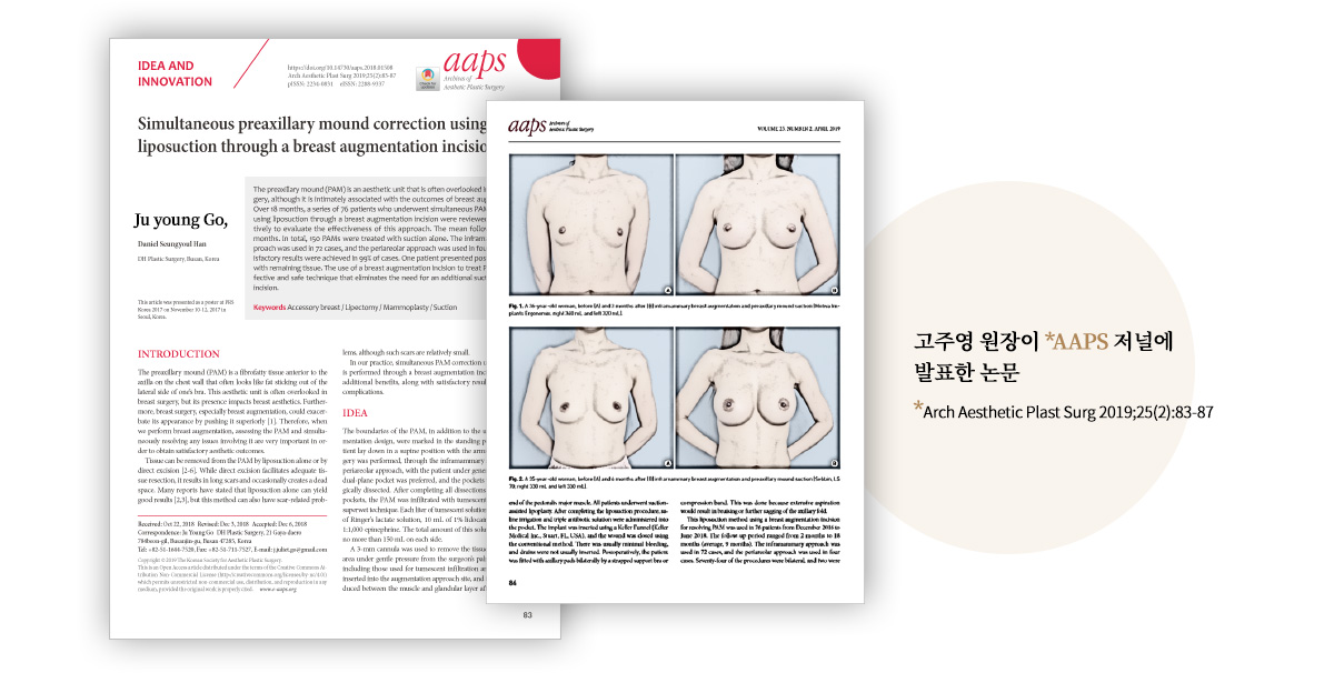 고주영 원장이 AAPS 저널에 발표한 논문(Arch Aesthetic Plast Surg 2019;25(2):83-87)
