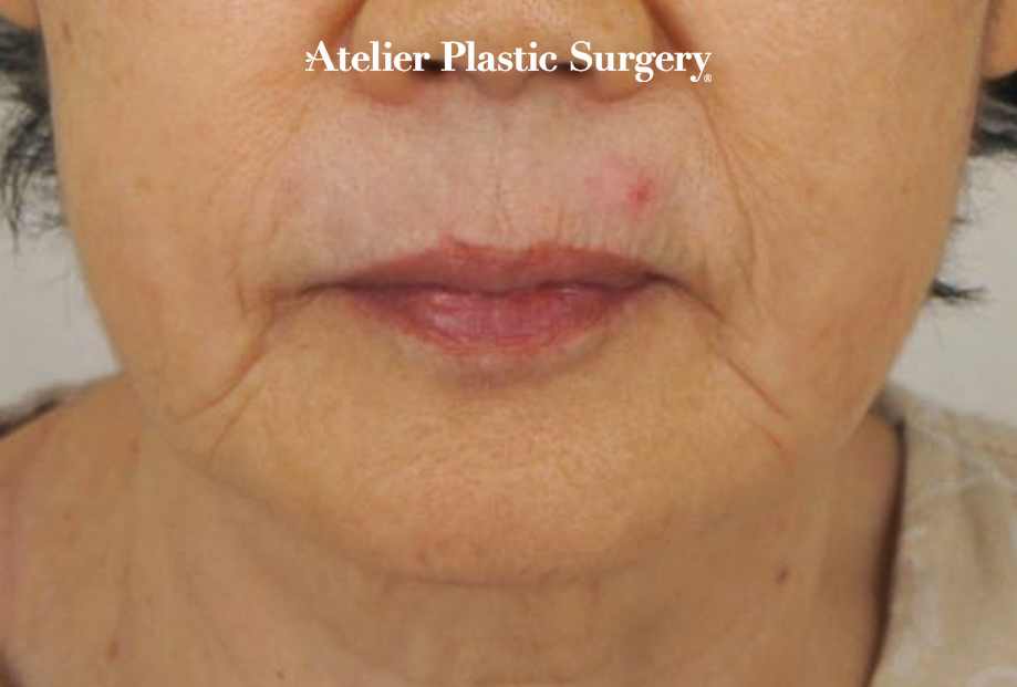 70대 안면거상 (face lifting) + 입술 필러, 무너진 턱 라인과 목주름 해결 더 건강한 입술 치료 전