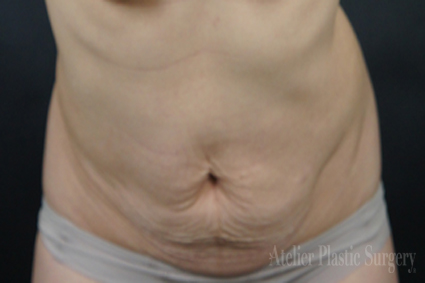 복부성형 + 배꼽성형 으로 자신있게 크롭티 입어볼까? 치료 전