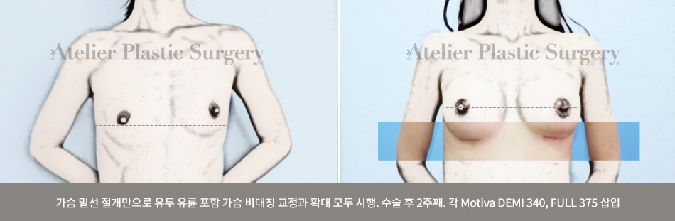 가슴 밑선 절개만으로 유두 유륜 포함 가슴 비대칭 교정과 확대 모두 시행. 수술 후 2주째. 각 Motiva DEMI 340, FULL 375 삽입